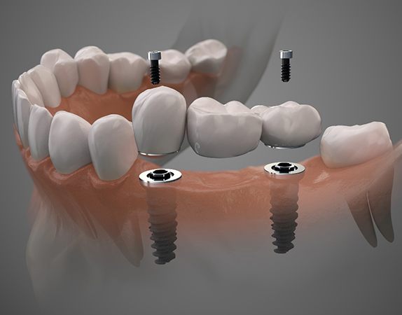 Digital illustration of a dental implant bridge