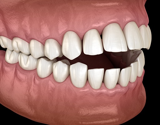 Smiling woman holding an Invisalign tray outdoors