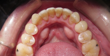 Close up of straightened teeth after Invisalign