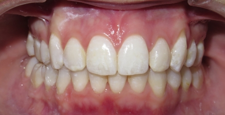 Close up of straightened teeth after Invisalign