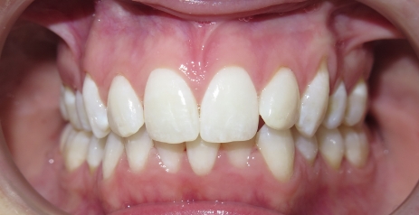 Close up of misaligned teeth before Invisalign