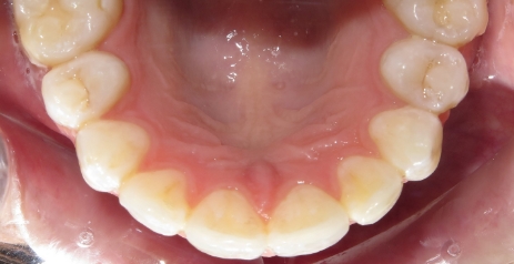 Close up of straightened teeth after Invisalign