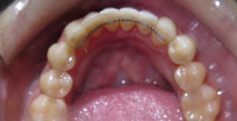 Close up of straightened teeth after Invisalign