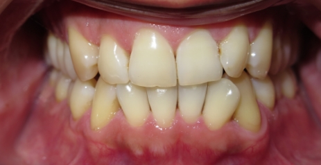 Close up of misaligned teeth before Invisalign