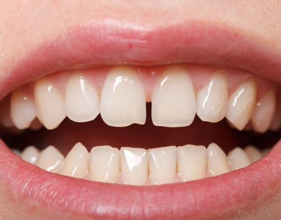 Smiling woman holding an Invisalign tray outdoors