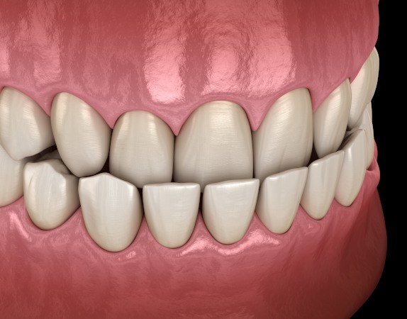 Smiling woman holding an Invisalign tray outdoors