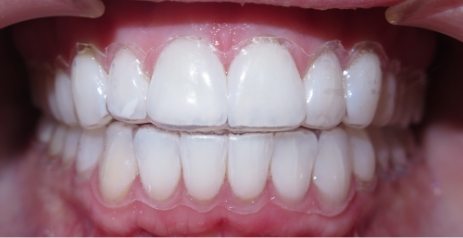 Close up of brighter teeth after Zoom teeth whitening